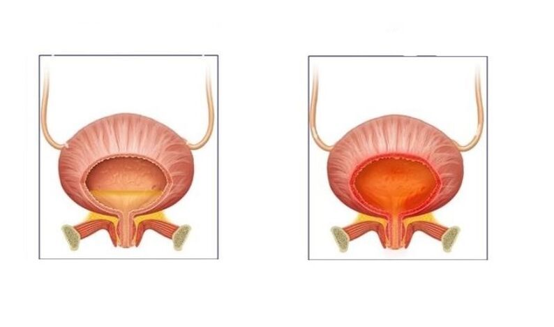 Normale e pazienti con infezione dalla vescica del tratto urinario